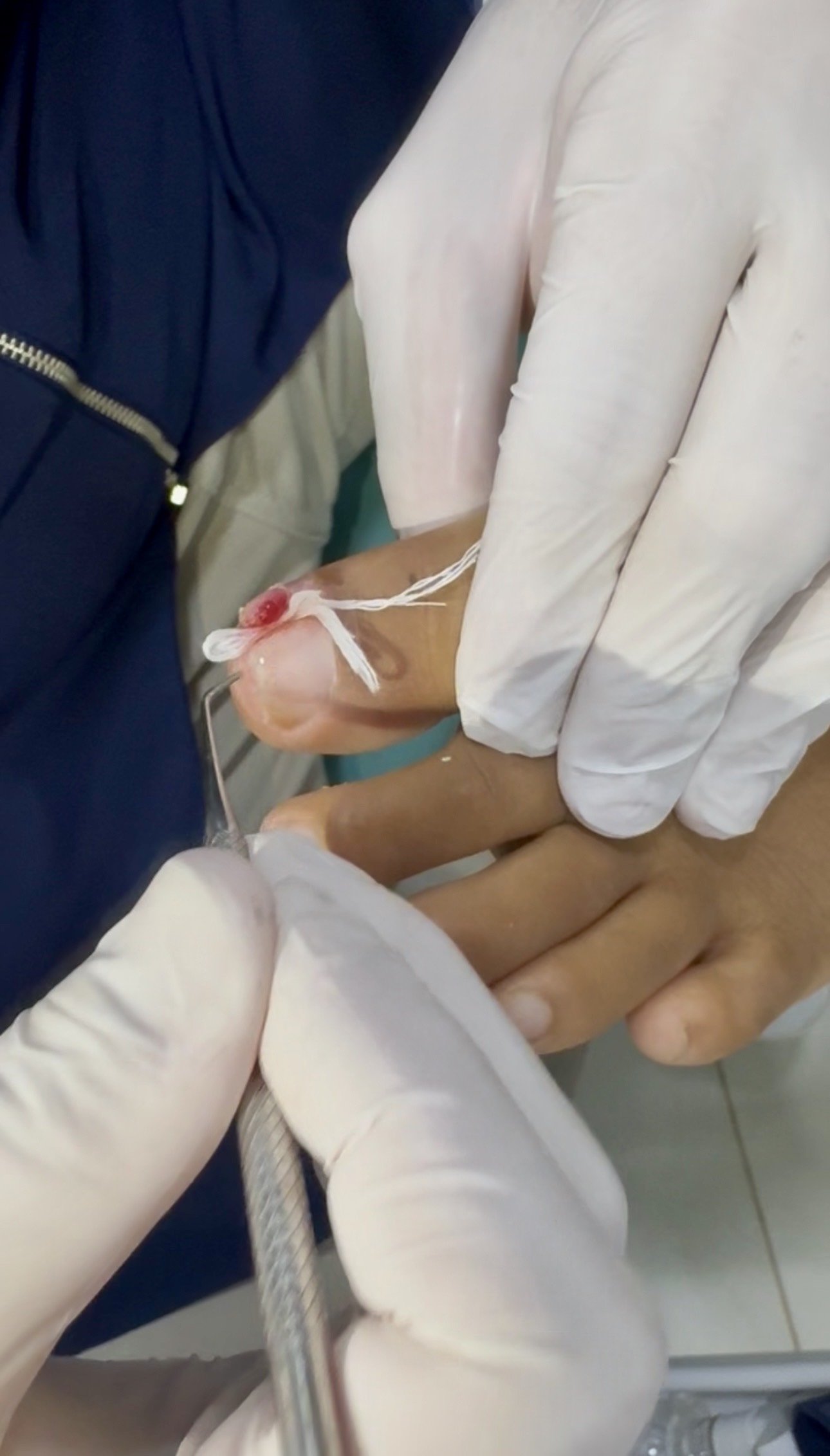 Analgesia tópica