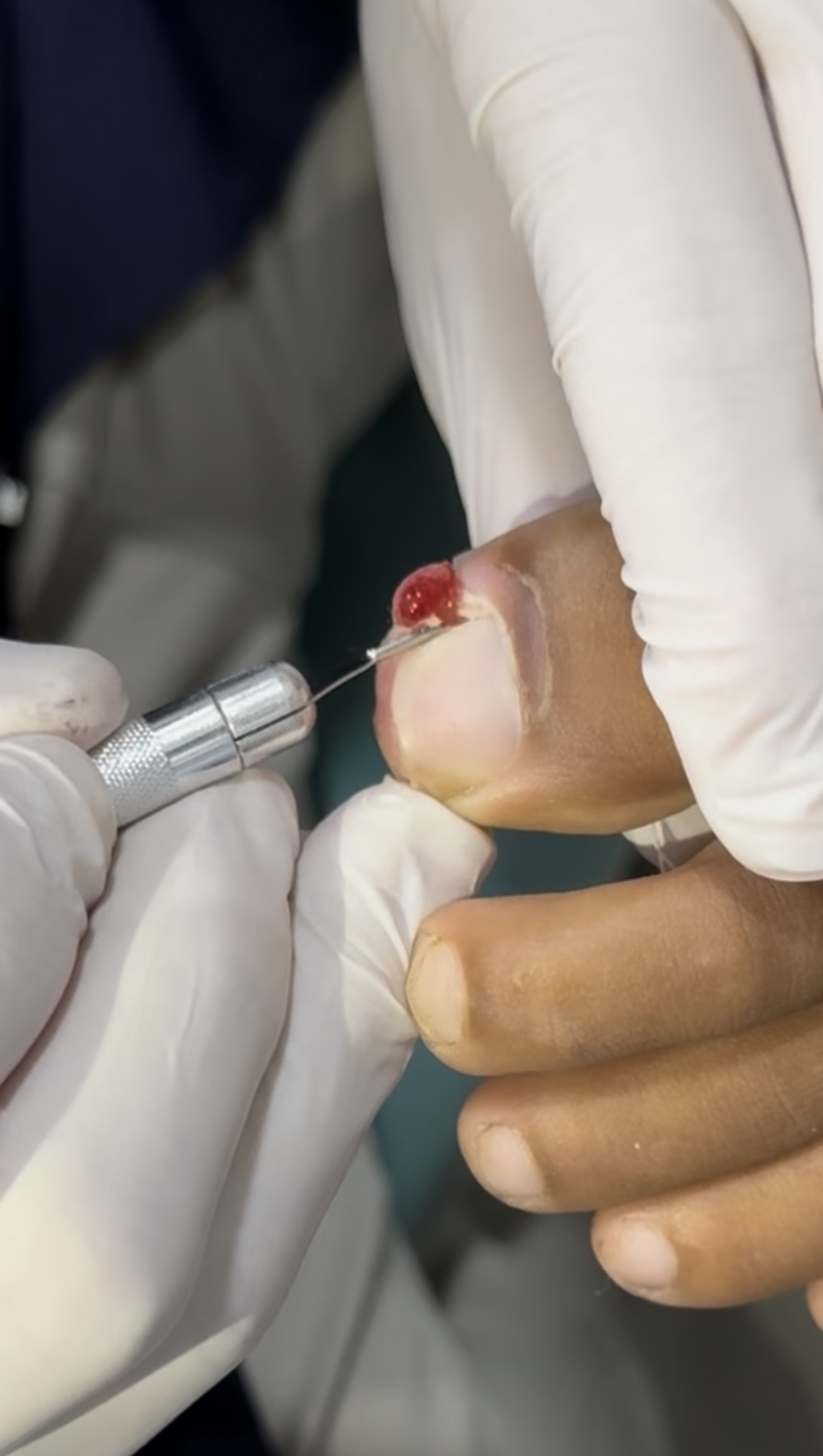 Espiculaectomia com lâmina de gúbia