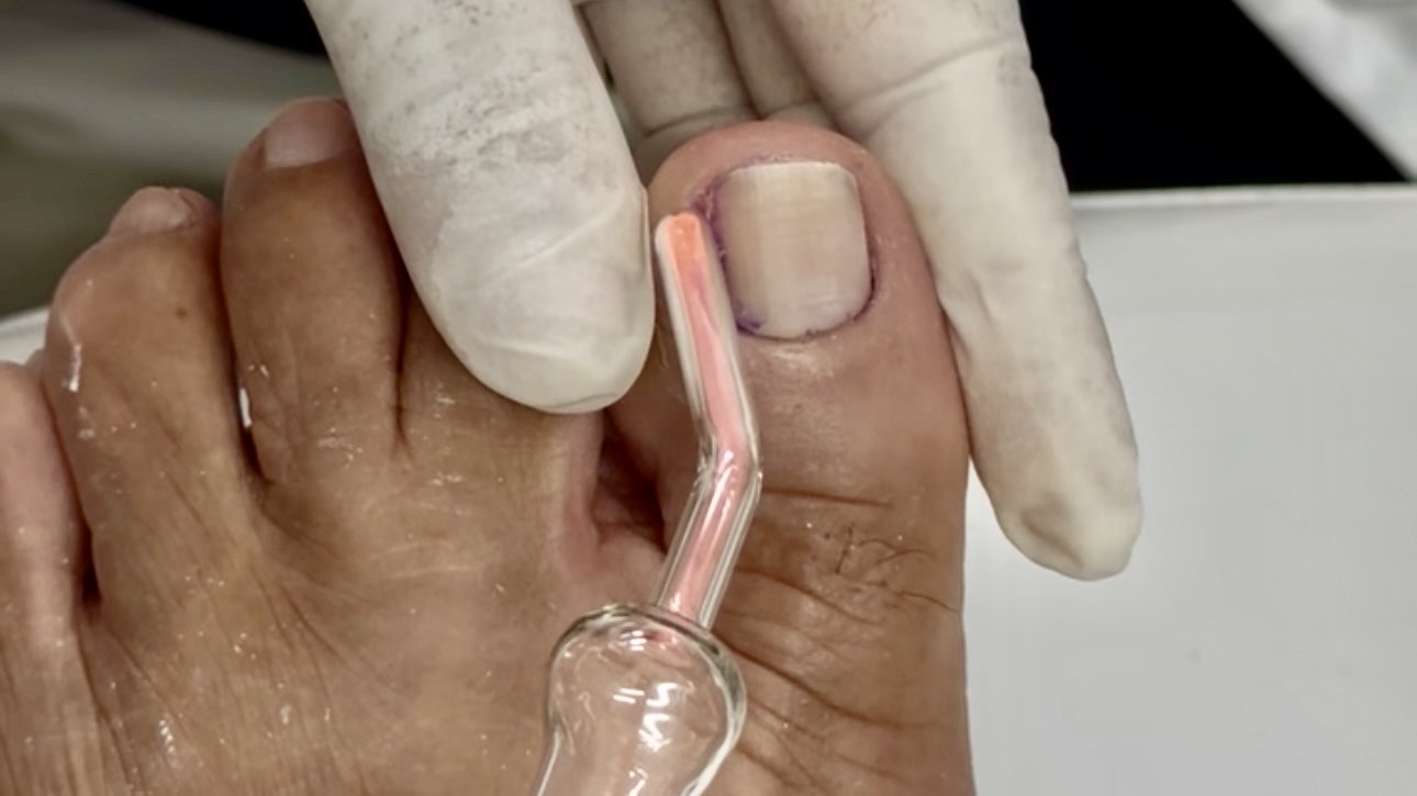 Cauterização de granulomas com Alta Frequência