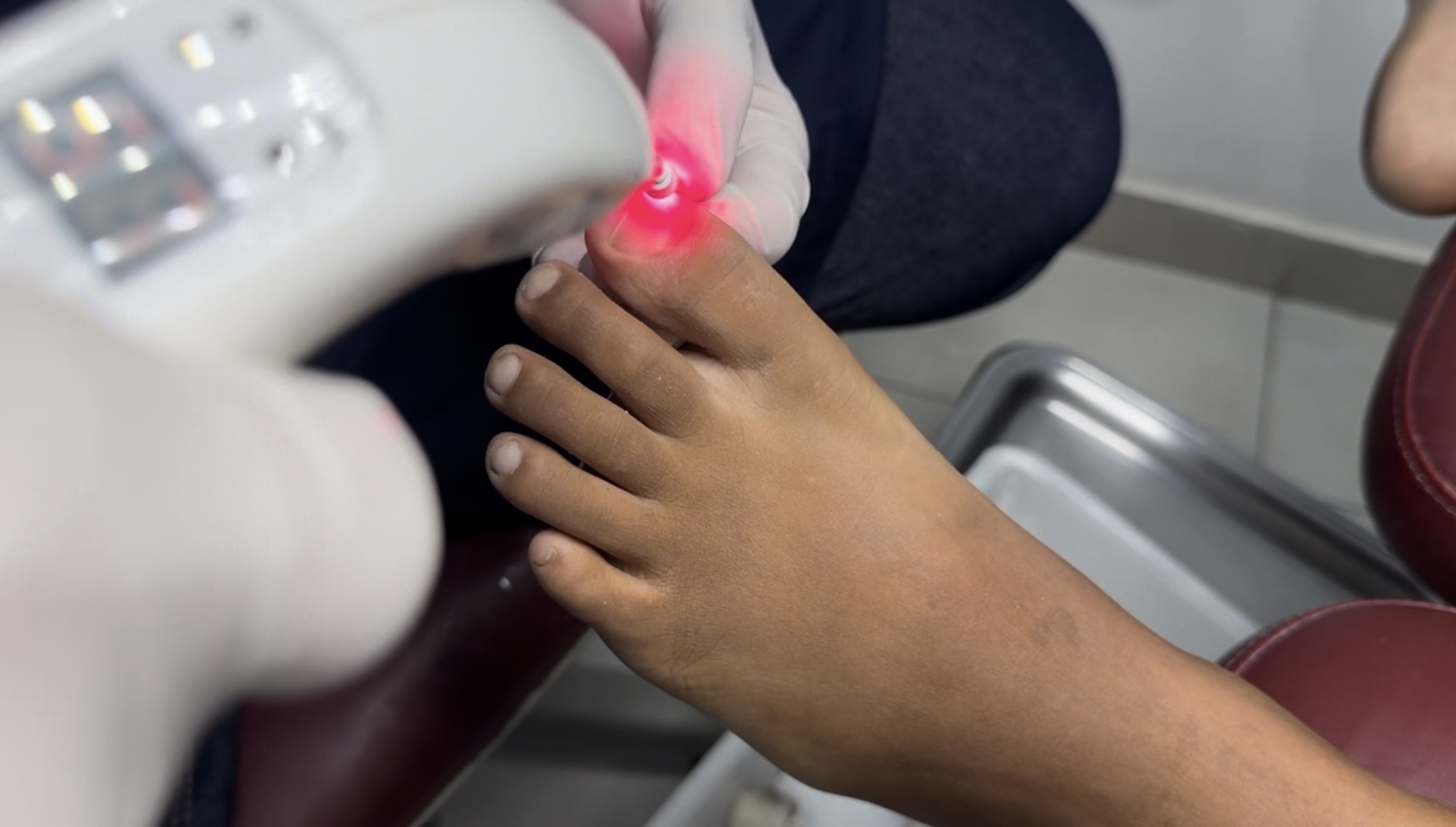 Acelerar a cicatrização com o laser terapêutico