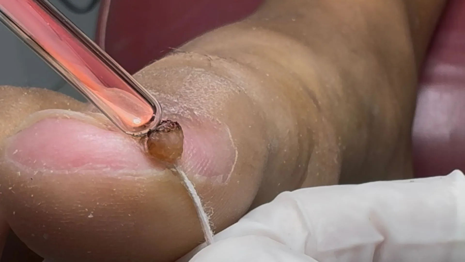 Alta Frequência aplicada na onicocriptose